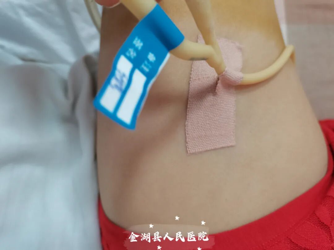 体表导管固定怎么使用护士巧用3M胶布制作了各类型的导管固定贴（安心贴）_https://www.jmylbn.com_新闻资讯_第7张