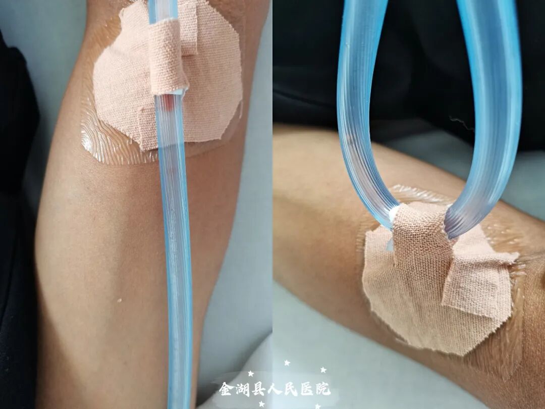 体表导管固定怎么使用护士巧用3M胶布制作了各类型的导管固定贴（安心贴）_https://www.jmylbn.com_新闻资讯_第8张