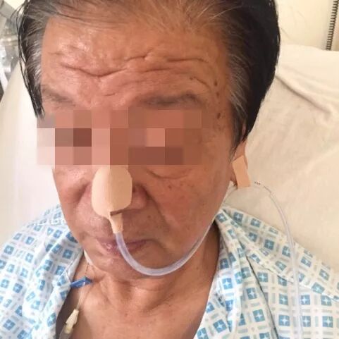 留置胃管鼻贴怎么贴留置胃管鼻贴花式贴法有T型、L型、P型...你用的是哪种？_https://www.jmylbn.com_新闻资讯_第12张