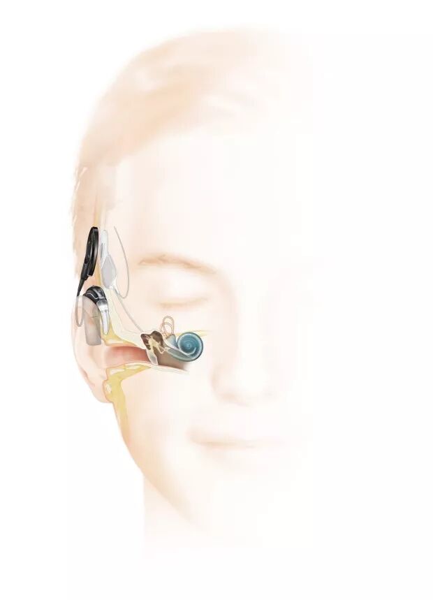 杂音困耳：科利耳（Cochlear）在美遭遇诉讼危机，股价创年内新低 - 8