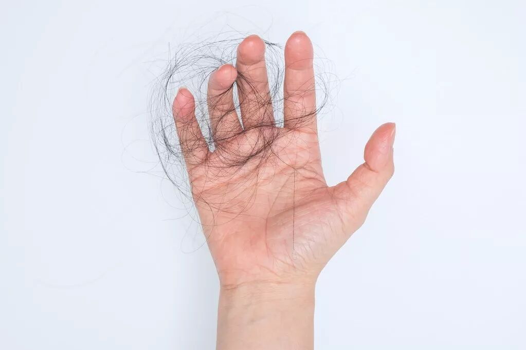 年纪轻轻就中了脱发的招？该怎么办？试试Somaderm HG