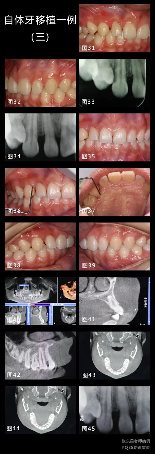 牙龈鼓包？这样切最干净
