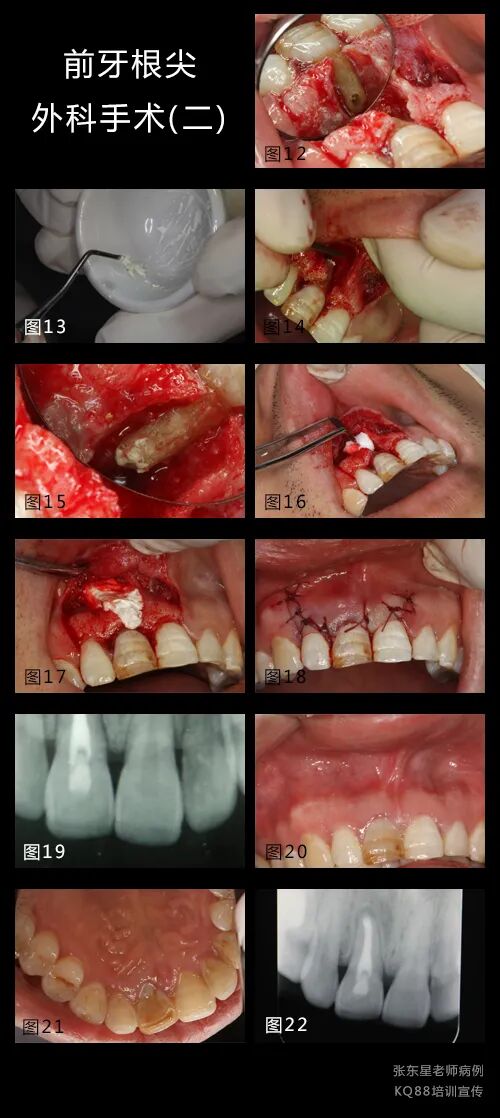 牙龈鼓包？这样切最干净