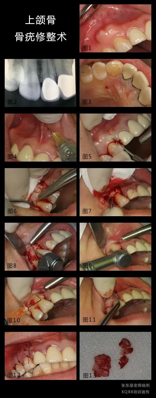 牙龈鼓包？这样切最干净