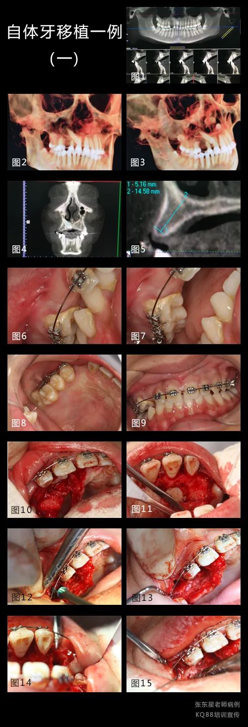 牙龈鼓包？这样切最干净