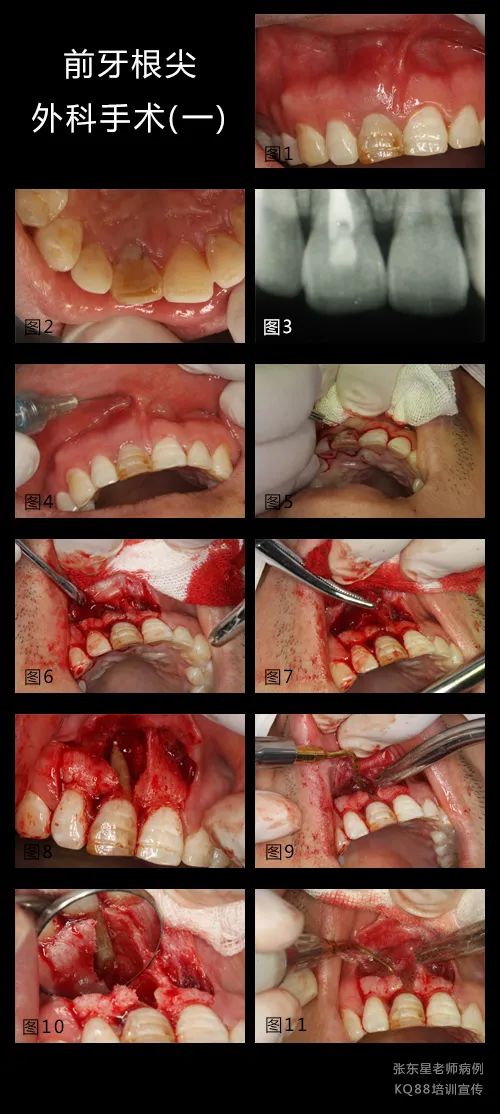 牙龈鼓包？这样切最干净