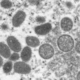 14国！以色列确诊首例猴痘，WHO：或有更多不明传播链病例