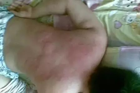 过敏、湿疹、荨麻疹，益生菌从根解决！