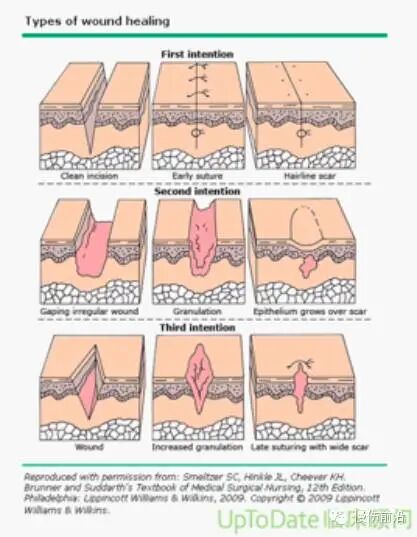 创面修复抗菌敷料怎么用【创面修复频道】伤口处理的基本原则。（聂邯洛医师推荐）_https://www.jmylbn.com_新闻资讯_第46张