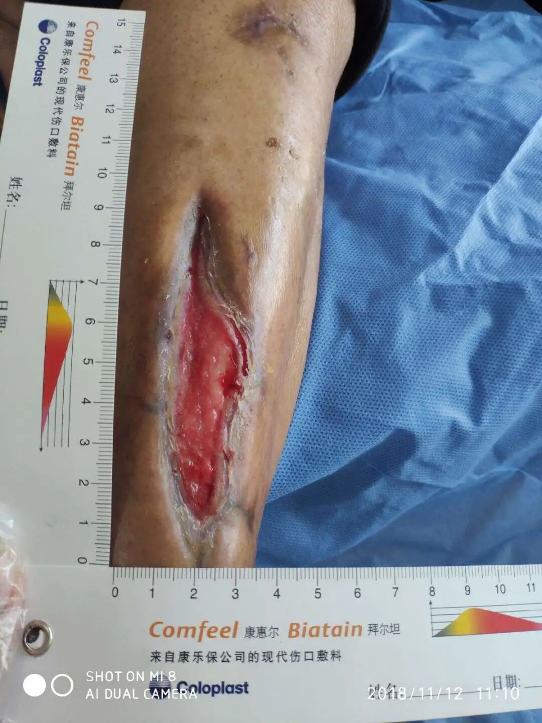 创面修复抗菌敷料怎么用【创面修复频道】伤口处理的基本原则。（聂邯洛医师推荐）_https://www.jmylbn.com_新闻资讯_第6张