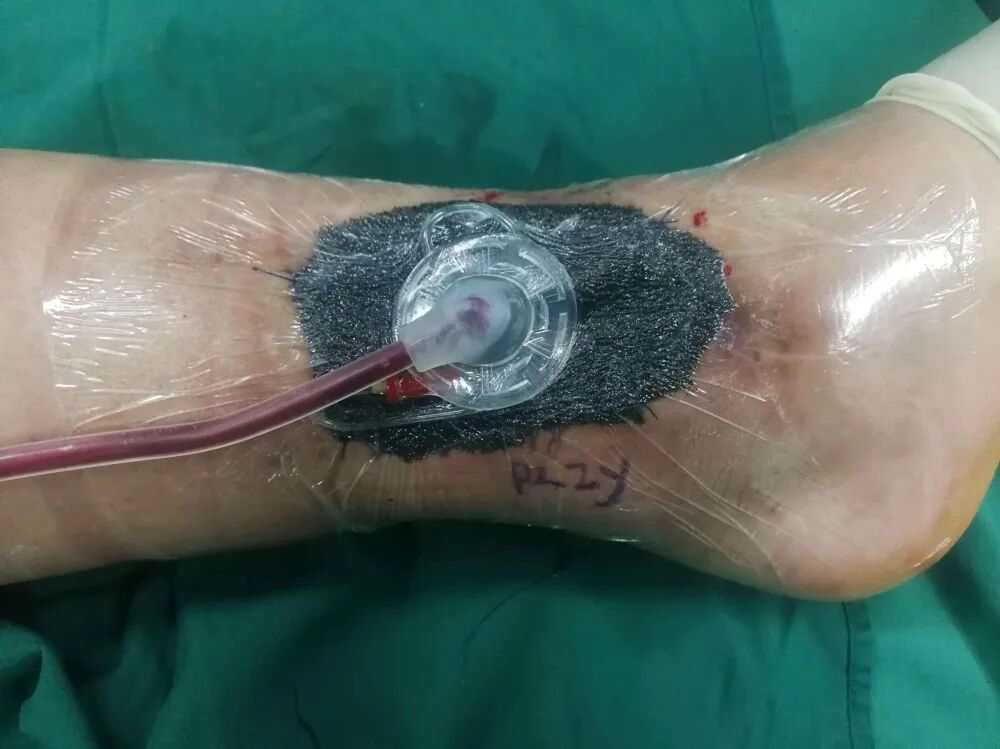 创面修复抗菌敷料怎么用【创面修复频道】伤口处理的基本原则。（聂邯洛医师推荐）_https://www.jmylbn.com_新闻资讯_第49张