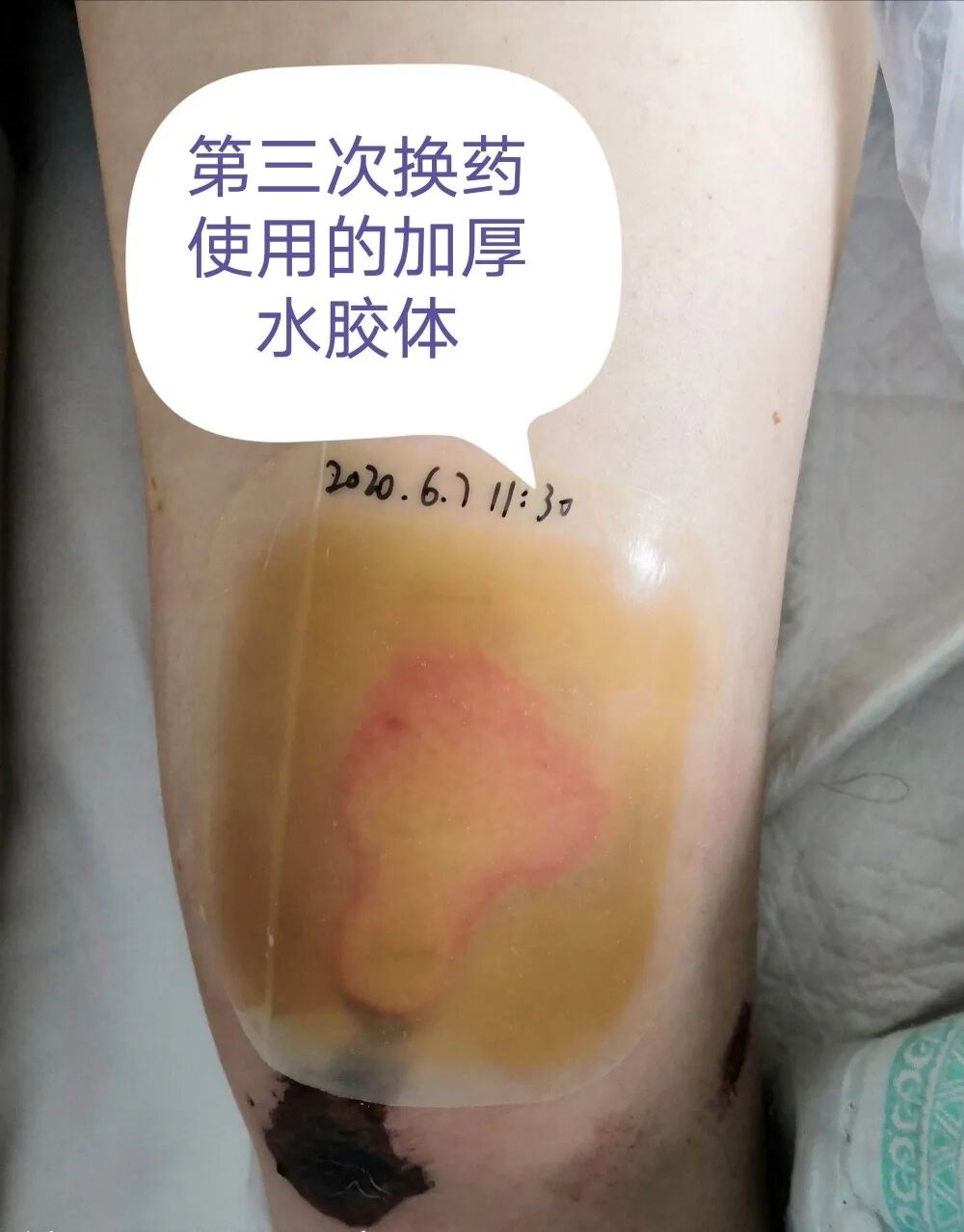 创面修复抗菌敷料怎么用【创面修复频道】伤口处理的基本原则。（聂邯洛医师推荐）_https://www.jmylbn.com_新闻资讯_第38张