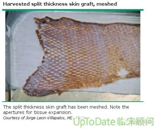 创面修复抗菌敷料怎么用【创面修复频道】伤口处理的基本原则。（聂邯洛医师推荐）_https://www.jmylbn.com_新闻资讯_第55张