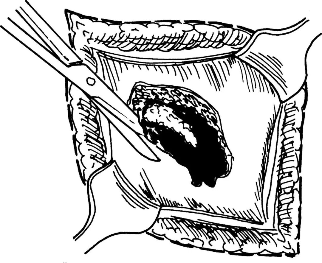 创面修复抗菌敷料怎么用【创面修复频道】伤口处理的基本原则。（聂邯洛医师推荐）_https://www.jmylbn.com_新闻资讯_第13张