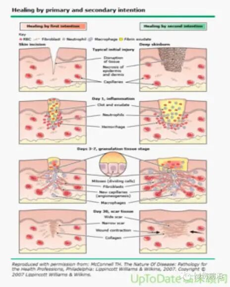 创面修复抗菌敷料怎么用【创面修复频道】伤口处理的基本原则。（聂邯洛医师推荐）_https://www.jmylbn.com_新闻资讯_第47张