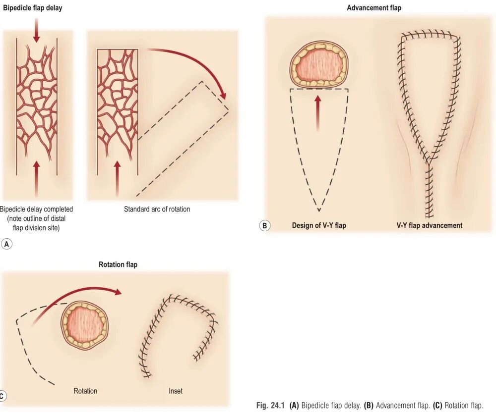 创面修复抗菌敷料怎么用【创面修复频道】伤口处理的基本原则。（聂邯洛医师推荐）_https://www.jmylbn.com_新闻资讯_第17张