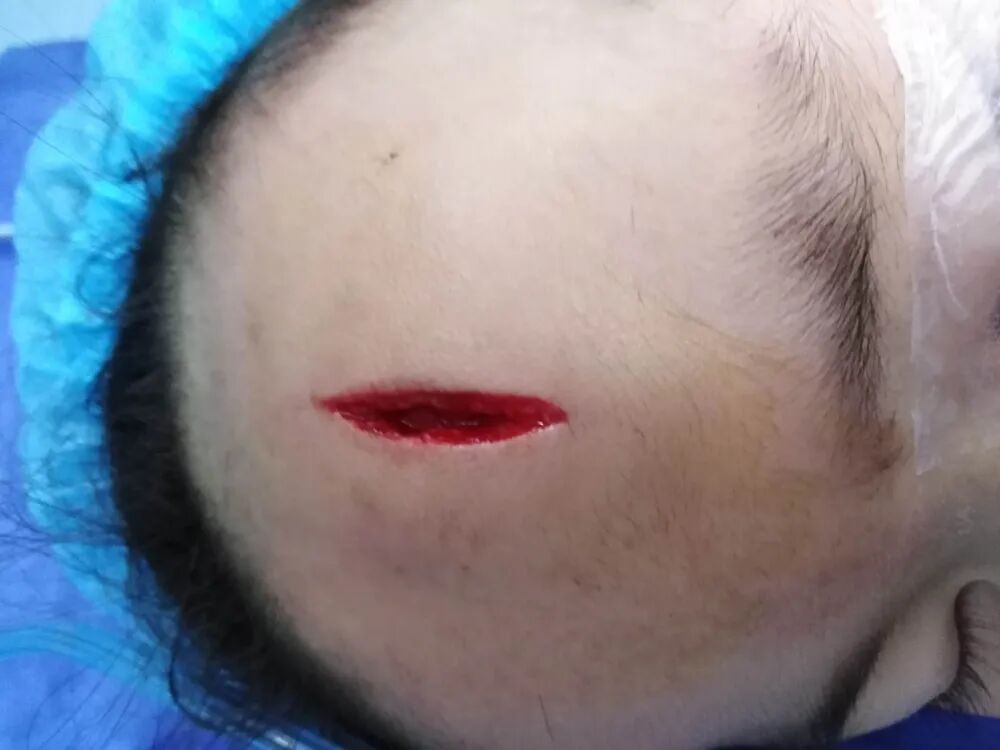 创面修复抗菌敷料怎么用【创面修复频道】伤口处理的基本原则。（聂邯洛医师推荐）_https://www.jmylbn.com_新闻资讯_第5张