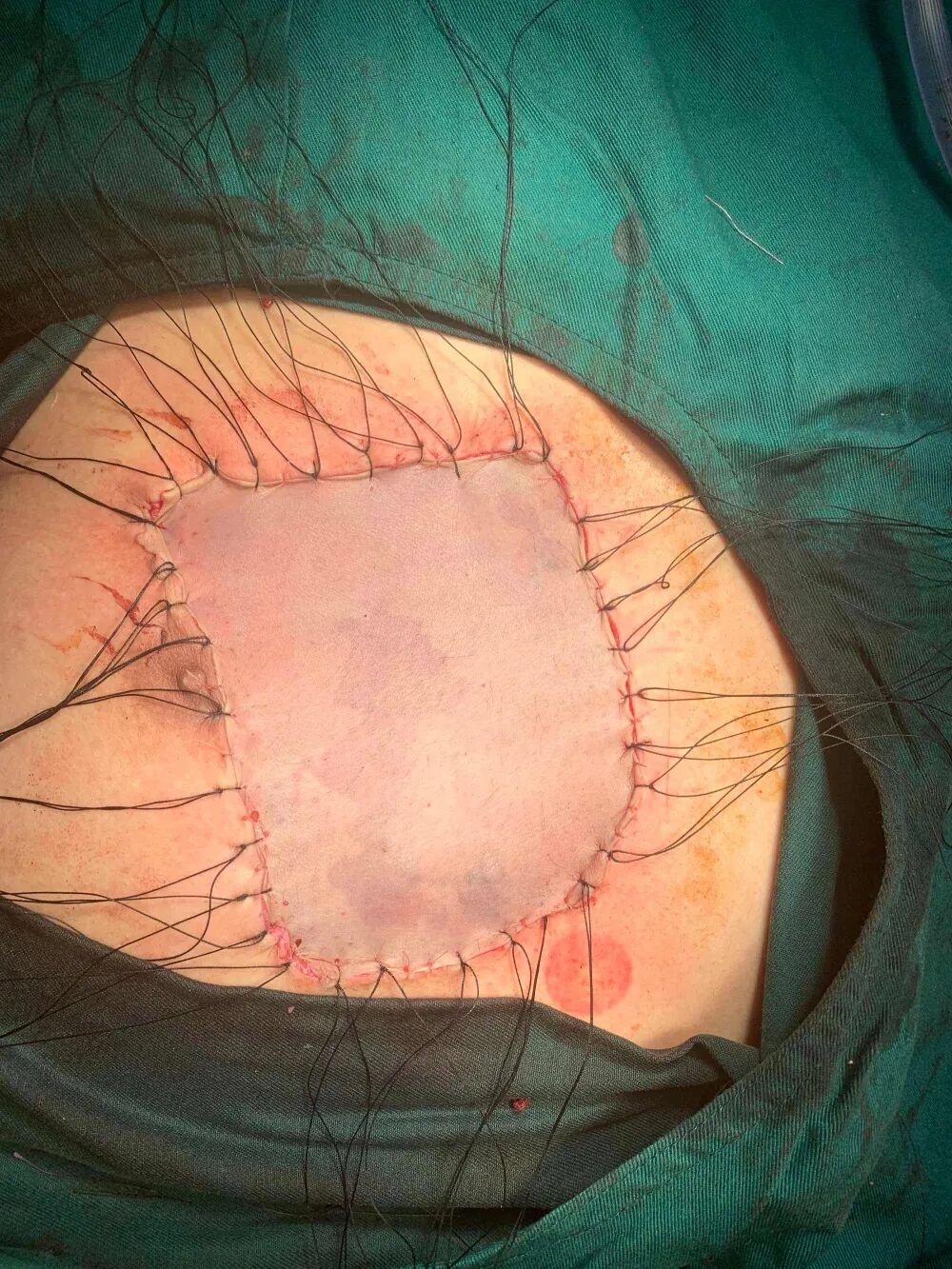 创面修复抗菌敷料怎么用【创面修复频道】伤口处理的基本原则。（聂邯洛医师推荐）_https://www.jmylbn.com_新闻资讯_第53张