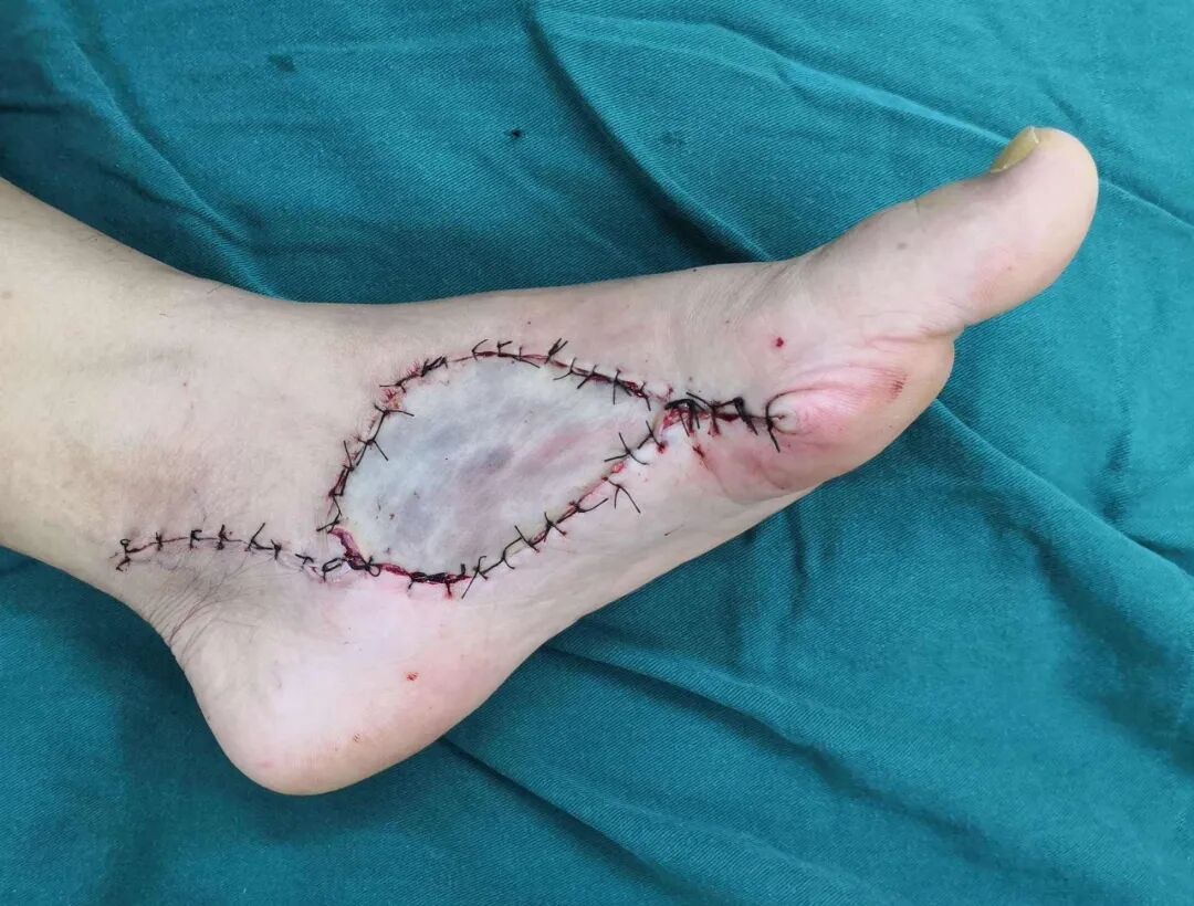 创面修复敷料怎么使用【创面修复频道】创面修复的常用概念。（聂邯洛医师推荐）_https://www.jmylbn.com_新闻资讯_第14张