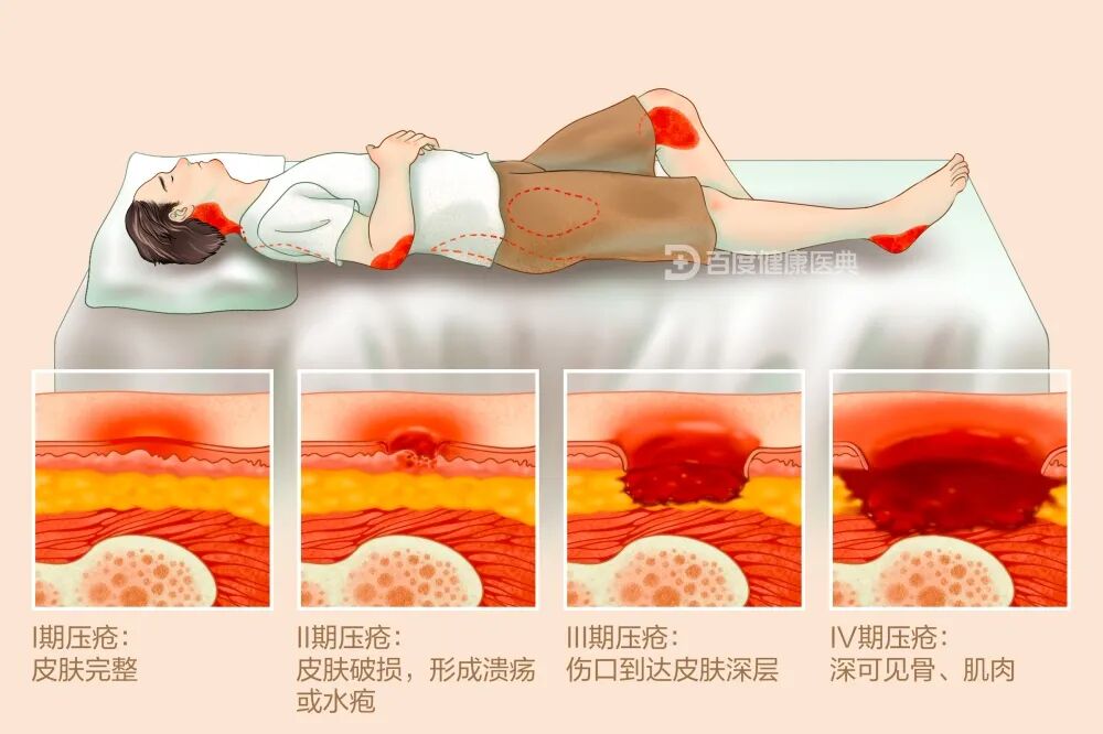 创面修复敷料怎么使用【创面修复频道】创面修复的常用概念。（聂邯洛医师推荐）_https://www.jmylbn.com_新闻资讯_第6张