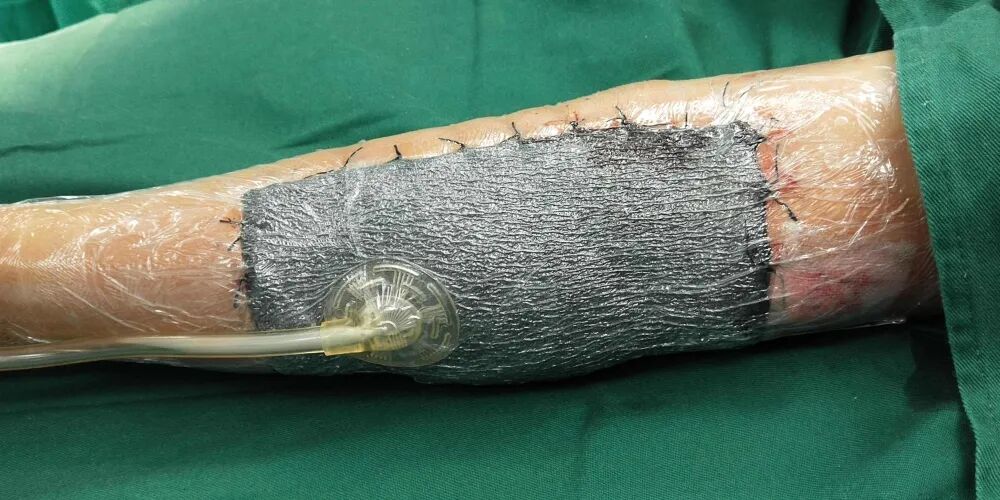 创面修复敷料怎么使用【创面修复频道】创面修复的常用概念。（聂邯洛医师推荐）_https://www.jmylbn.com_新闻资讯_第12张