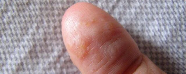 手癣有传染性，引起手癣的原因是什么？