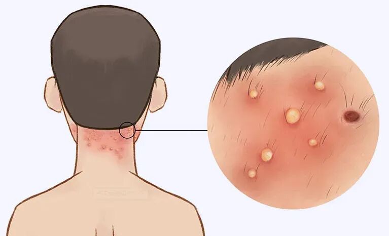 毛囊炎久拖不治的四个危害，你知道吗？