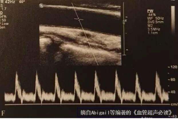 什么是超声容积探头血流量测定 ｜取样容积和角度θ_https://www.jmylbn.com_新闻资讯_第4张