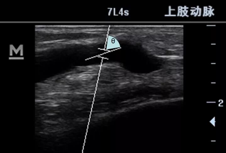 什么是超声容积探头血流量测定 ｜取样容积和角度θ_https://www.jmylbn.com_新闻资讯_第6张