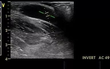 什么是超声容积探头血流量测定 ｜取样容积和角度θ_https://www.jmylbn.com_新闻资讯_第10张