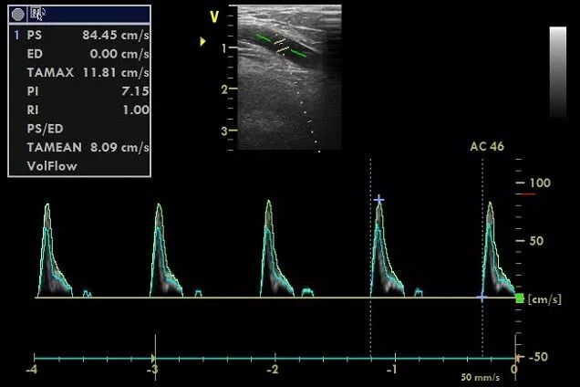 什么是超声容积探头血流量测定 ｜取样容积和角度θ_https://www.jmylbn.com_新闻资讯_第7张
