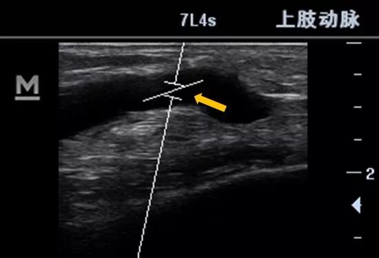 什么是超声容积探头血流量测定 ｜取样容积和角度θ_https://www.jmylbn.com_新闻资讯_第2张