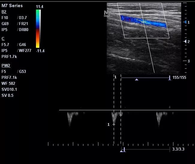 什么是超声容积探头血流量测定 ｜取样容积和角度θ_https://www.jmylbn.com_新闻资讯_第12张