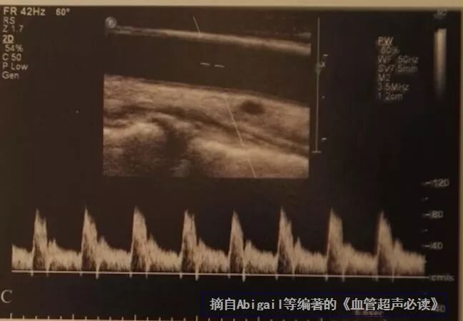 什么是超声容积探头血流量测定 ｜取样容积和角度θ_https://www.jmylbn.com_新闻资讯_第5张