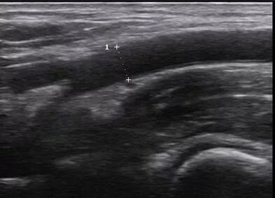 什么是超声容积探头血流量测定 ｜取样容积和角度θ_https://www.jmylbn.com_新闻资讯_第8张