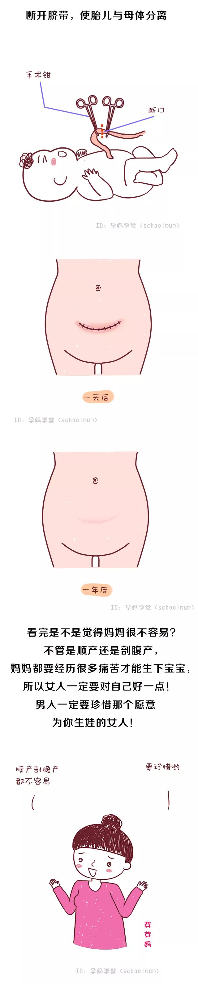 做一次剖腹产 需要经历这几个步骤 妈妈们真伟大 孕妈学堂 二十次幂