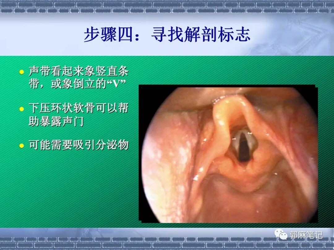喉镜怎么选型号关于小儿气管插管术及并发症处理_https://www.jmylbn.com_新闻资讯_第20张