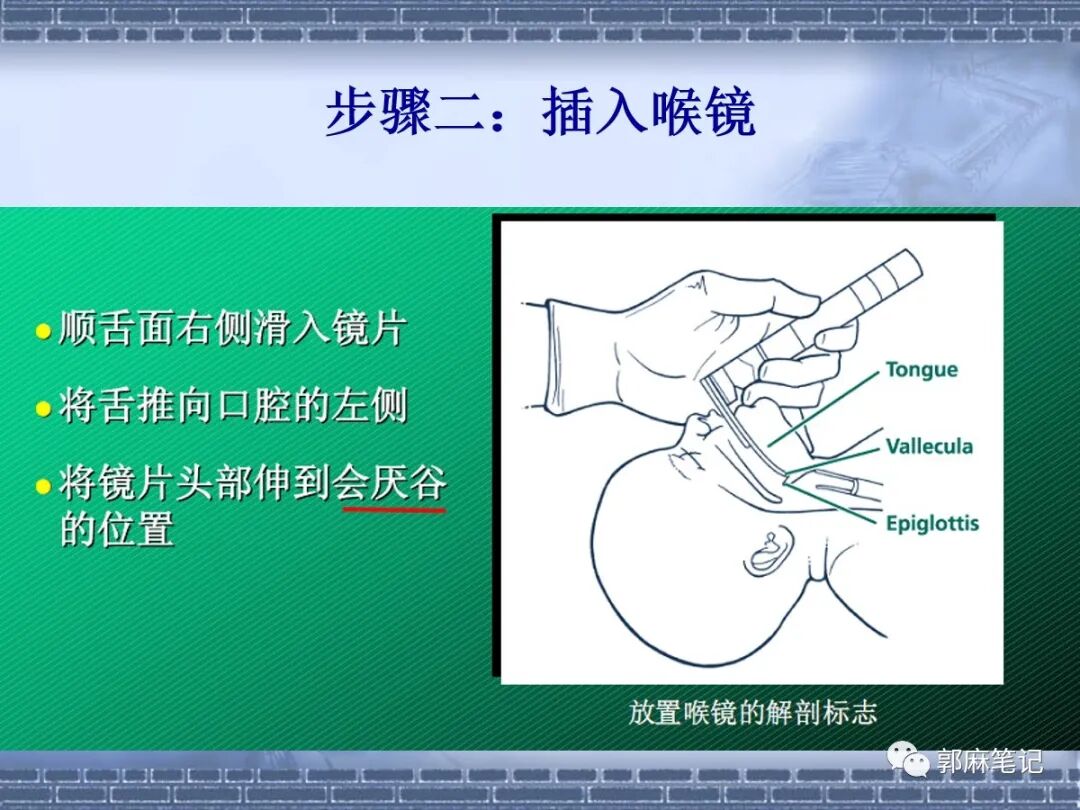 喉镜怎么选型号关于小儿气管插管术及并发症处理_https://www.jmylbn.com_新闻资讯_第18张