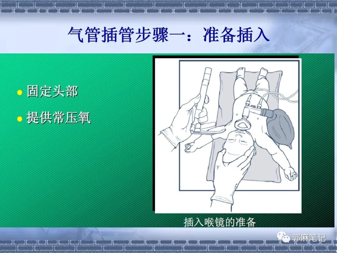 喉镜怎么选型号关于小儿气管插管术及并发症处理_https://www.jmylbn.com_新闻资讯_第17张