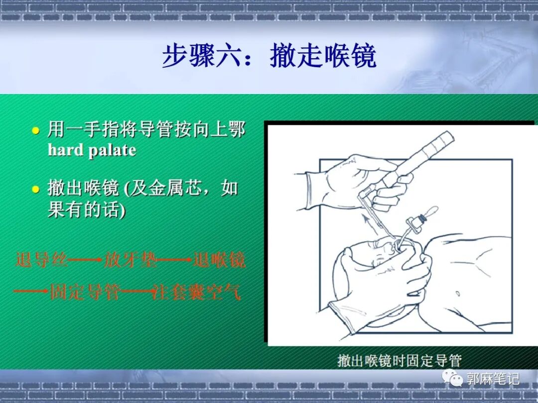 喉镜怎么选型号关于小儿气管插管术及并发症处理_https://www.jmylbn.com_新闻资讯_第22张