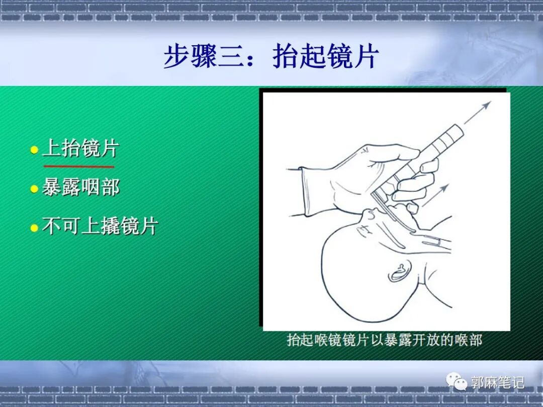 喉镜怎么选型号关于小儿气管插管术及并发症处理_https://www.jmylbn.com_新闻资讯_第19张
