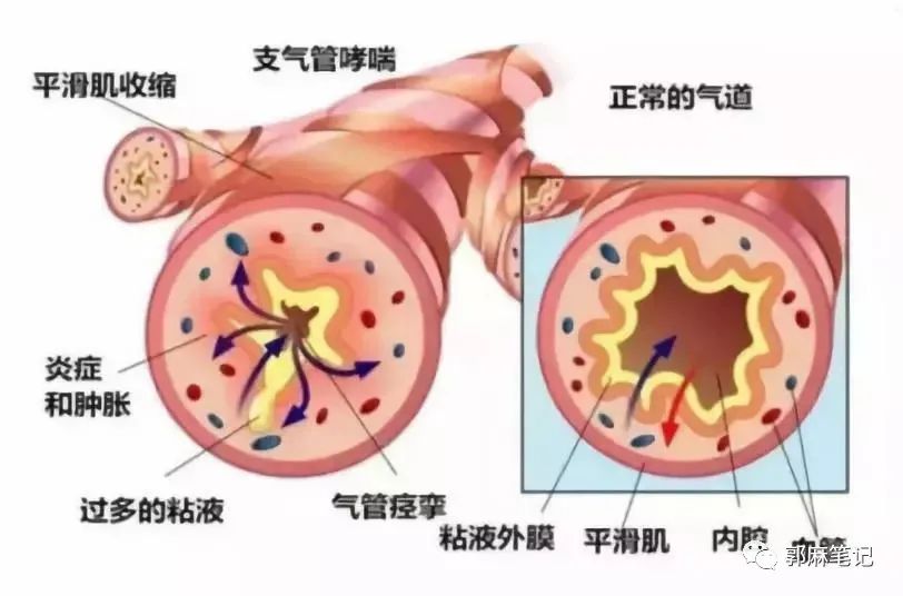 支气管痉挛麻醉医生"感冒是小事儿,但是感冒的时候被麻醉可能会发生