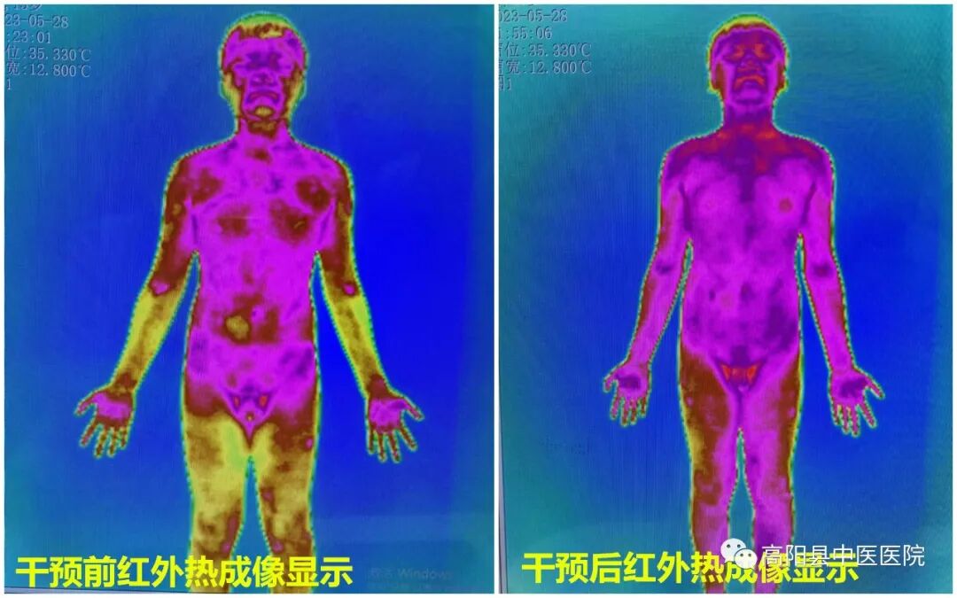 医用红外热像仪怎么开机【特色技术】我院引进红外热像仪，“一眼看穿”你的健康状况！_https://www.jmylbn.com_新闻资讯_第8张