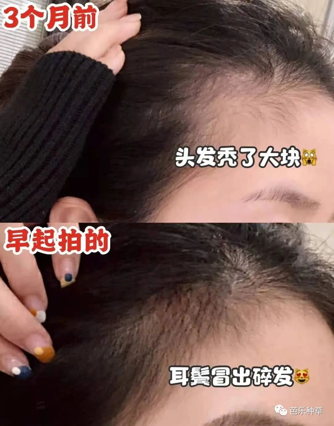 医用脱毛剂怎么用长生堂生发液超牛逼的生发水／脱毛症治疗剂，真的有效！没任何副作用如果你也有秃头，掉发，脱发严重，找它就行！3瓶一疗程，坚持使用！_https://www.jmylbn.com_新闻资讯_第10张