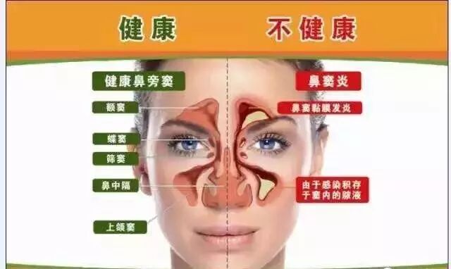 鼻炎为什么要早护理！它可能引发这5种疾病！