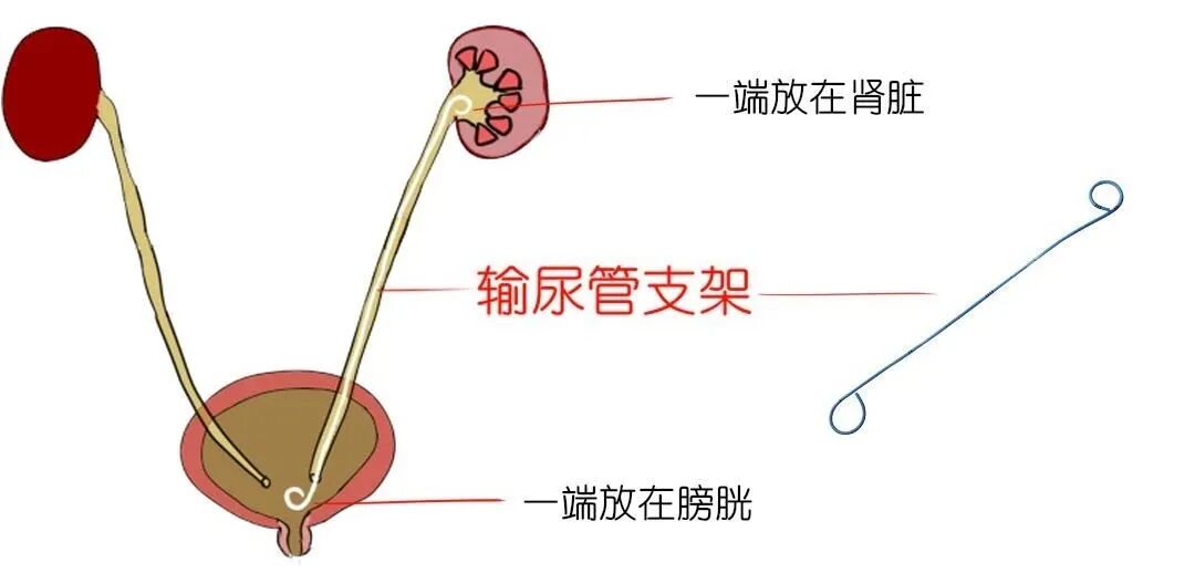 猪输尿管怎么吃双J管、猪尾管，傻傻分不清!输尿管支架，你知道多少？_https://www.jmylbn.com_新闻资讯_第3张