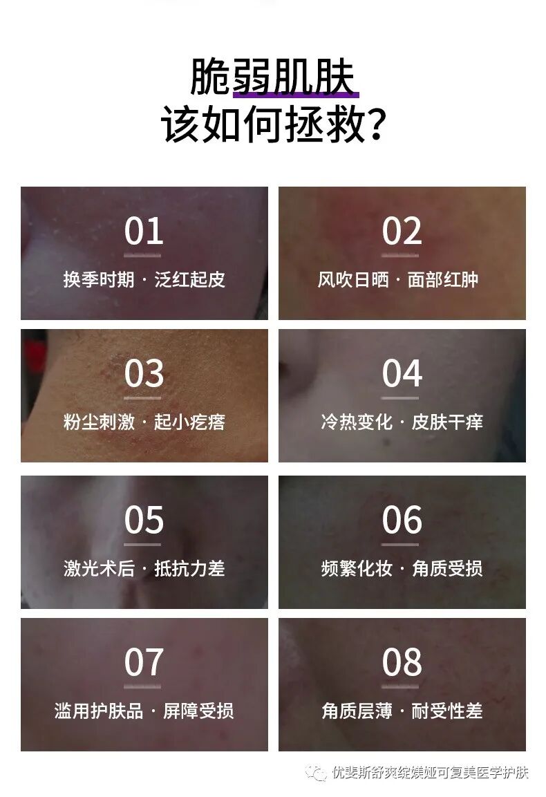 液体敷料喷雾怎么用三分做七分养，医美术后如何修复？   优斐斯喷雾 优斐斯液体敷料褪黑型传明酸 艺霏 可预 博乐达 拜瑞格 百植萃_https://www.jmylbn.com_新闻资讯_第19张