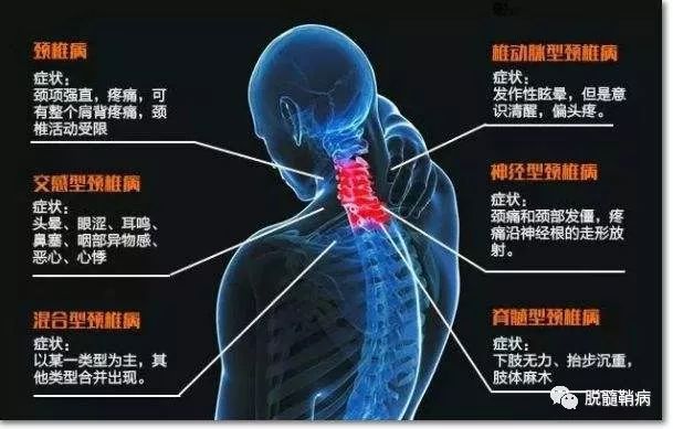 脊髓炎有哪些潜在危害 脱髓鞘病 微信公众号文章阅读 Wemp