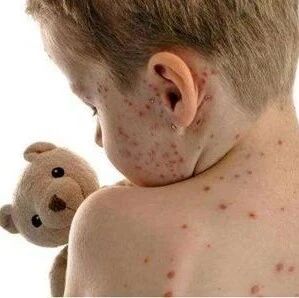 孩子腿上出现大量红斑 、紫癜！家长该引起重视了！