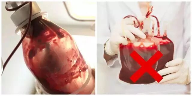 高压臭氧治疗什么高剂量高压臭氧自血疗法（HOT）“净化血液提高免疫”_https://www.jmylbn.com_新闻资讯_第7张